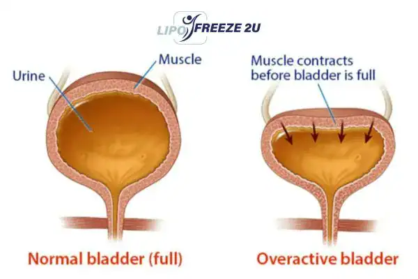 diagram of overactive bladder treatment Bicester
