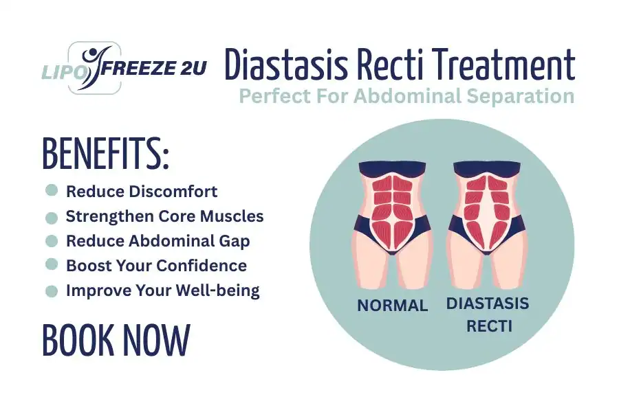 How Long Will It Take to See Improvements in Diastasis Recti Bicester
