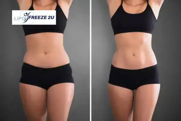 How Can LIPO FREEZE 2U Support Your Post-Pregnancy Body Recovery Bicester?
