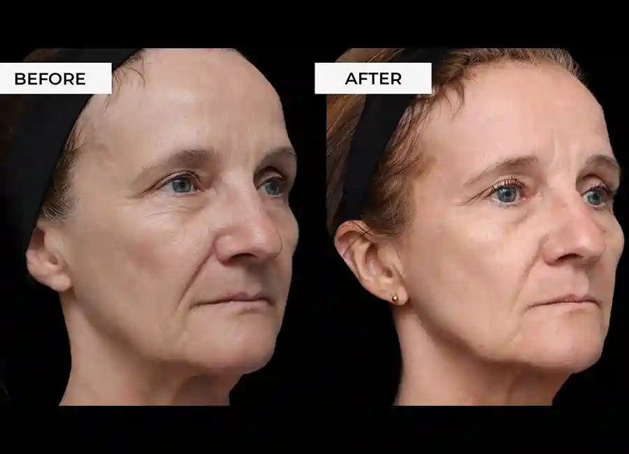 How Many RF Microneedling Sessions Will You Need to See a Difference Bicester?