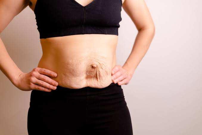Is Surgery Really the Only Way to Repair Diastasis Recti Bicester?