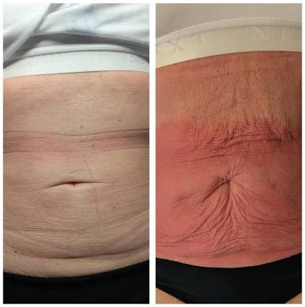 How Does RF Microneedling Improve Crepey, Thin and Uneven Skin Texture Bicester?
