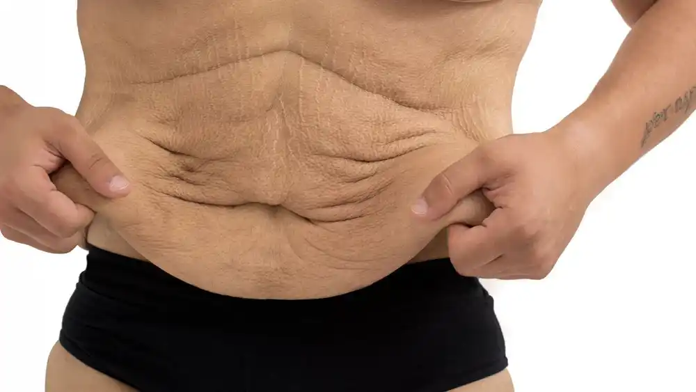 Why Does Weight Loss Medication Leave Some People With Loose or Sagging Skin Bicester?